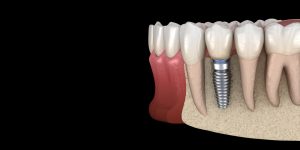 bone graft for dental implants.