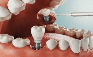 single dental implant.