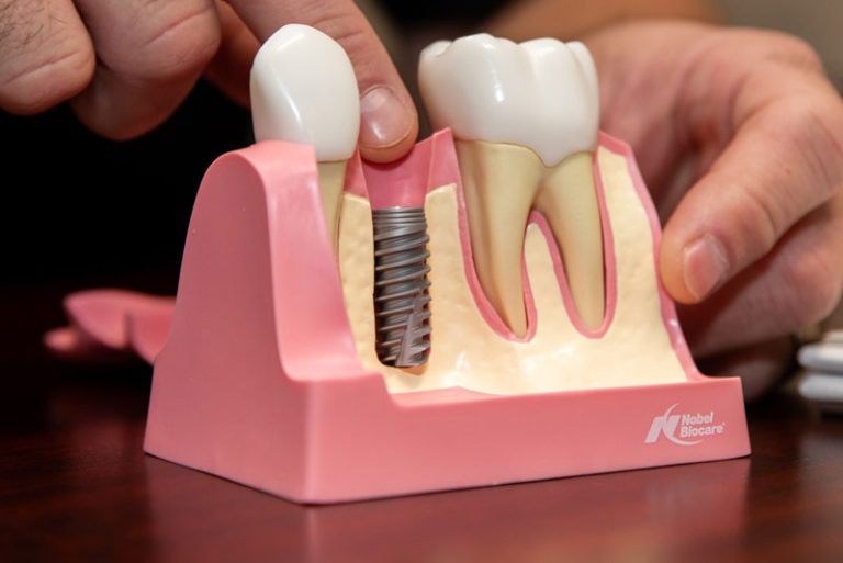 dental implants model.