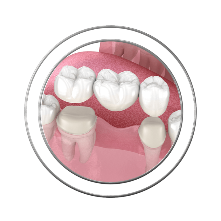3D illustration of a dental bridge at J.P Prosthodontics in Fullerton, CA