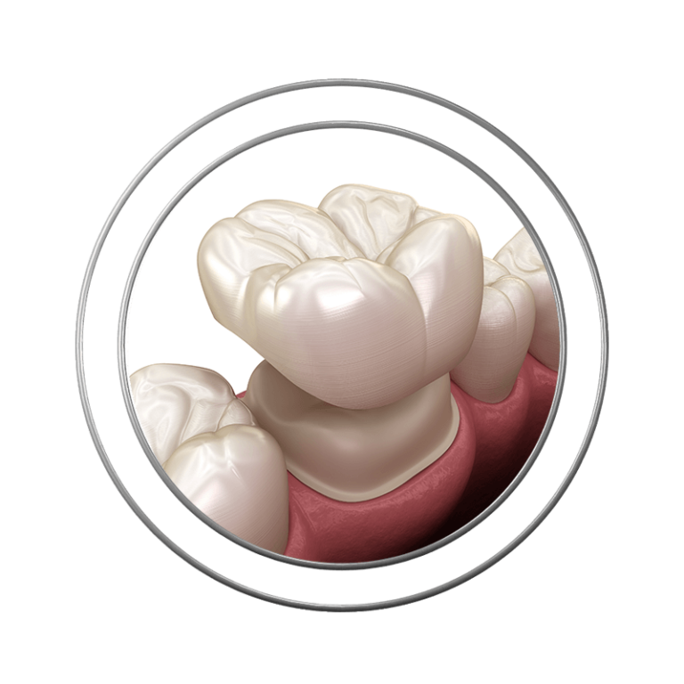 Stylized illustration of dental crowns at J.P Prosthodontics in Fullerton, CA