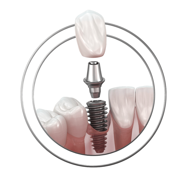 3D offset model showing components of a dental implant at J.P Prosthodontics in Fullerton, CA