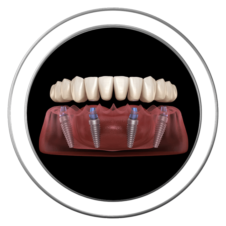 3D model of full arch dental implants at J.P Prosthodontics in Fullerton, CA