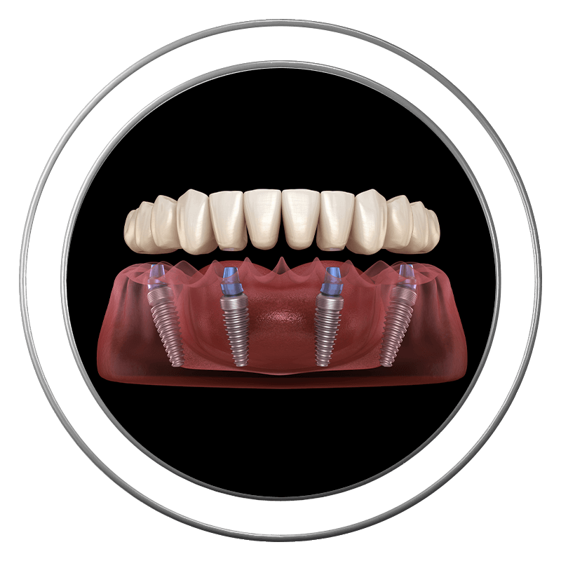 3D illustration of full arch dental implants at J.P Prosthodontics in Fullerton, CA