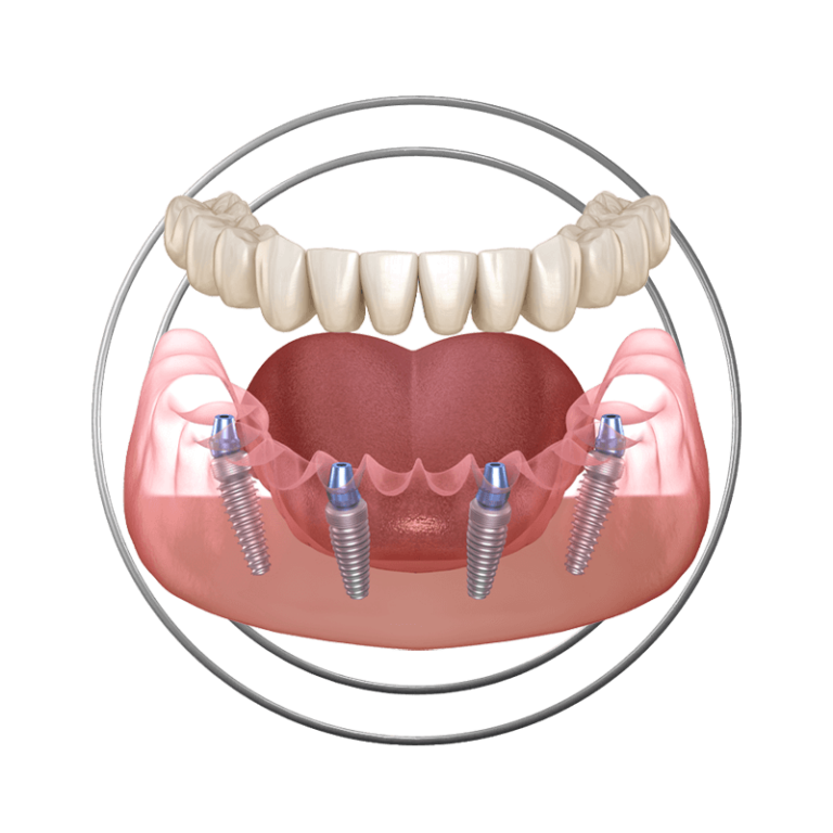 Stylized 3D illustration of full arch dental implants at J.P Prosthodontics in Fullerton, CA
