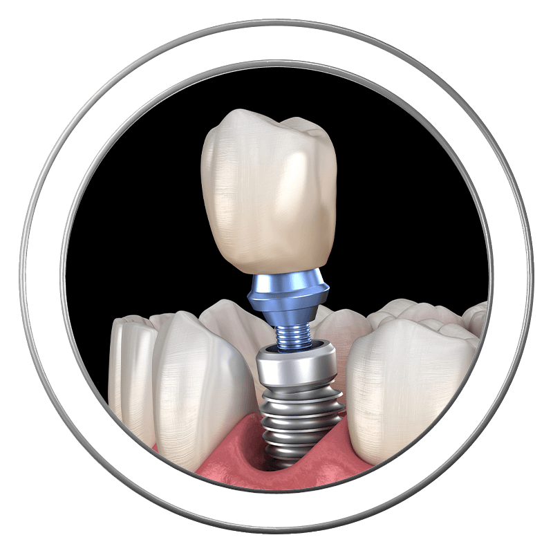 3D model of a silver dental implant used at J.P Prosthodontics in Fullerton, CA