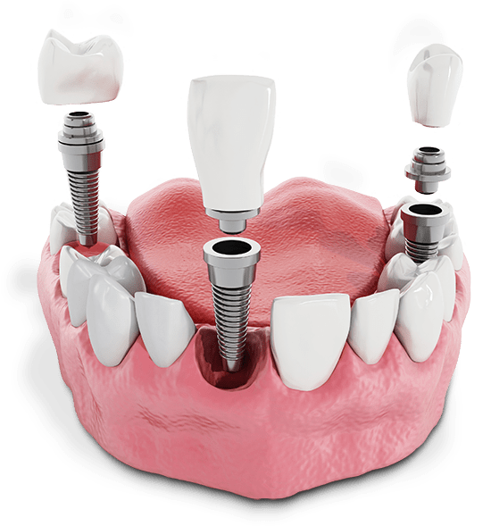 Illustration of multiple dental implants at J.P Prosthodontics in Fullerton, CA