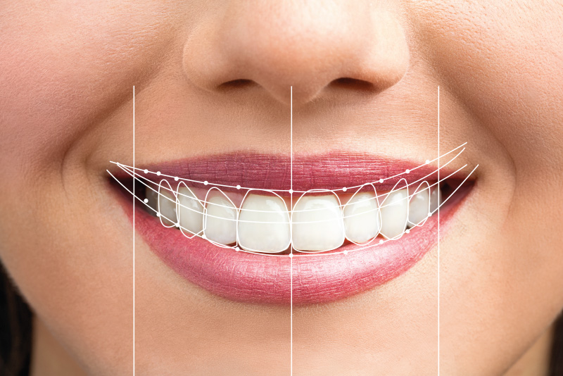 Digital smile preview showing expected treatment results at J.P Prosthodontics in Fullerton, CA