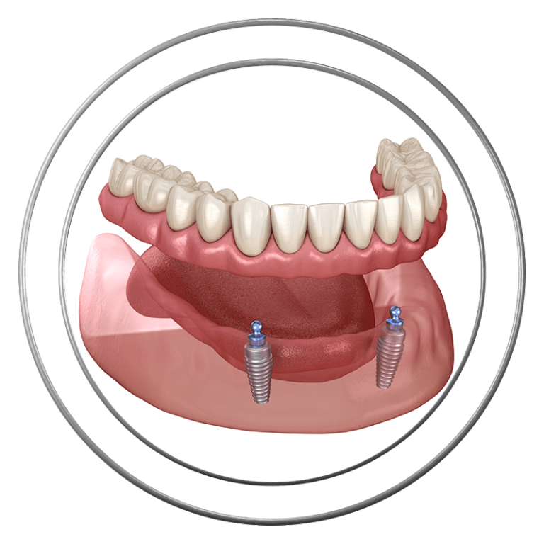 3D model of a snap-on denture at J.P Prosthodontics in Fullerton, CA