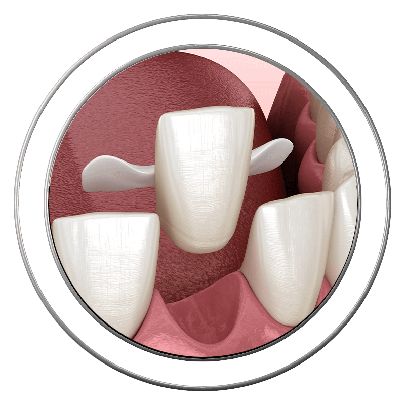 Tooth bonding illustration showing dental restoration at J.P Prosthodontics in Fullerton, CA
